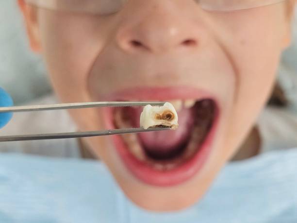 Best Emergency Wisdom Tooth Extraction in Kings Park, NY